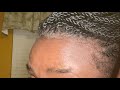 Regrowing your hair line