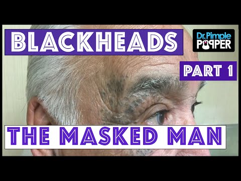 Return Of The Masked Man: Blackhead Extractions! | Session 3, Part 1