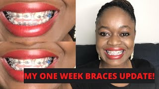 1 WEEK BRACES UPDATE!/WHAT TO EXPECT/PROCESS/PROGRESS/PAIN/STORY TIME, WHY I GOT BRACES ON.