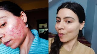 HOW TO CURE ACNE/HOW TO CURE PIMPLES