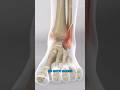 Ankle Fracture Surgery 3D Animation Ankle Fracture Surgery 3D Animation