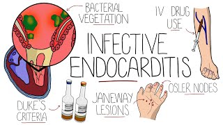 Infective Endocarditis (With Duke Criteria & Pathophysiology)