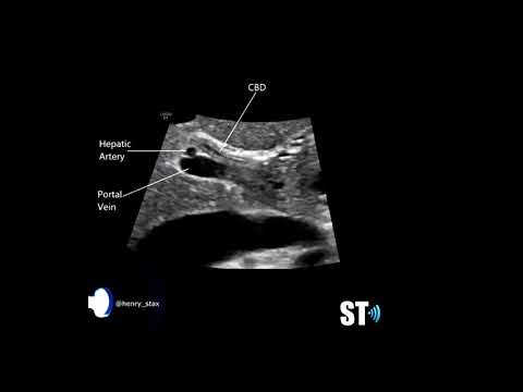 Scanning the Common Bile Duct CBD