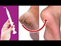 Wow In Just 5 Minutes!! Get Rid of CRACKED HEELS Permanently - Magical Cracked Heels Home Remedy