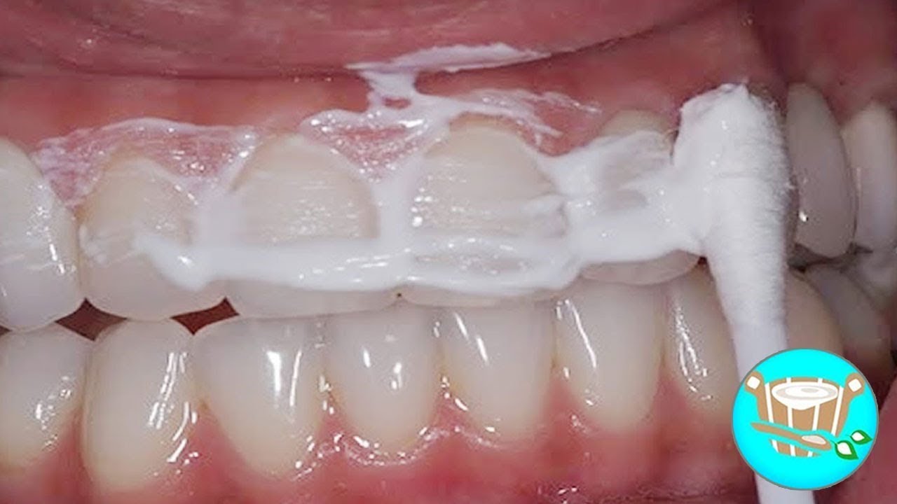 Blanquear dientes con bicarbonato