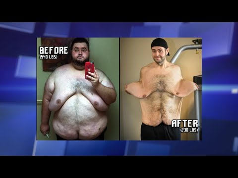 Losing over 300 Pounds Has Left Man with Significant Excess Skin