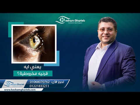 فيديو أ.د. هشام غريب عن القرنية المخروطية