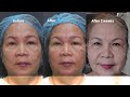 Frown line treatment with PDO Bomb , Botox and BellaPro