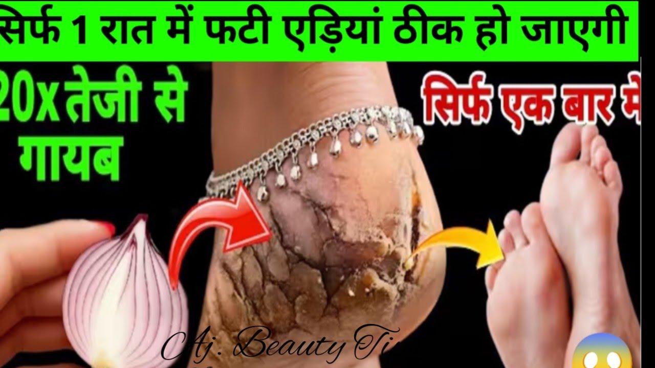 7 Din Me Payein Makhmali Ediyan|Fati Ediyon ka Pakka Illaj Cracked Heels Home Remedy| cracked heels|
