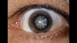 Eye Drops That Dissolve Cataracts!!!