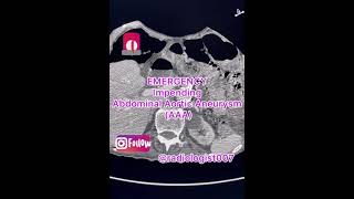 Impending Abdominal Aortic Aneurysm (AAA) rupture