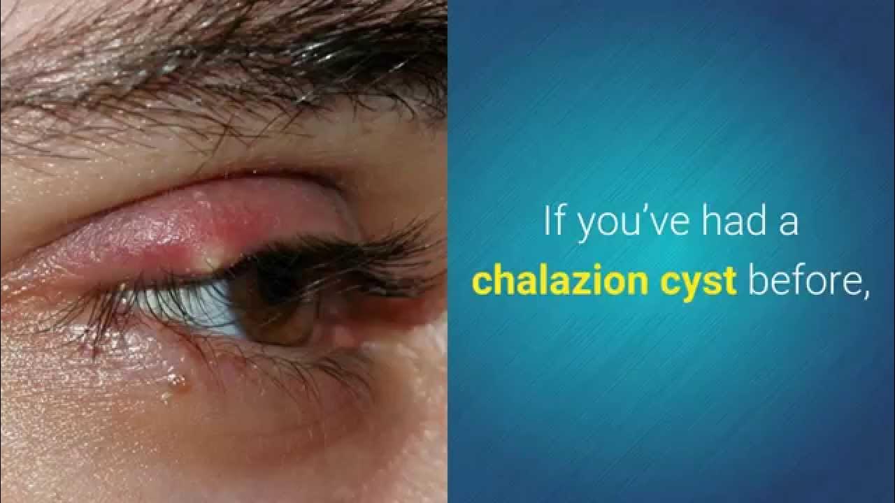 chalazion-prevention-tips-to-prevent-a-chalazion-from-coming-back