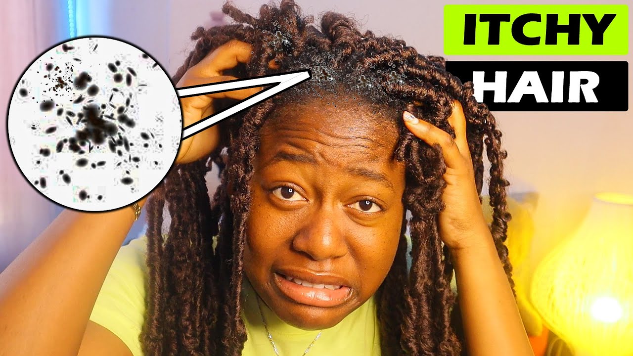 How To Stop Itchy Scalp **The Easy Method** YouTube