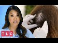 Patient Has a Huge Lipoma on the Back of Her Head! | Dr. Pimple Popper