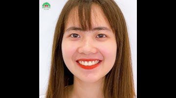 Tháo niềng xong hóa mỹ nhân cùng nụ cười tỏa nắng