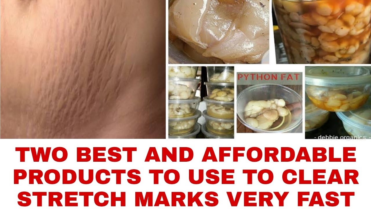 TWO BEST AND AFFORDABLE PRODUCTS TO CLEAR STRETCH MARKS SUPER FAST | REMOVE STRETCH MARKS VERY FAST