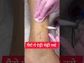 ScleroTherapy #shorts #youtubeshorts #nurse #nursing #healthtips #medical #hospital #injection #yt
