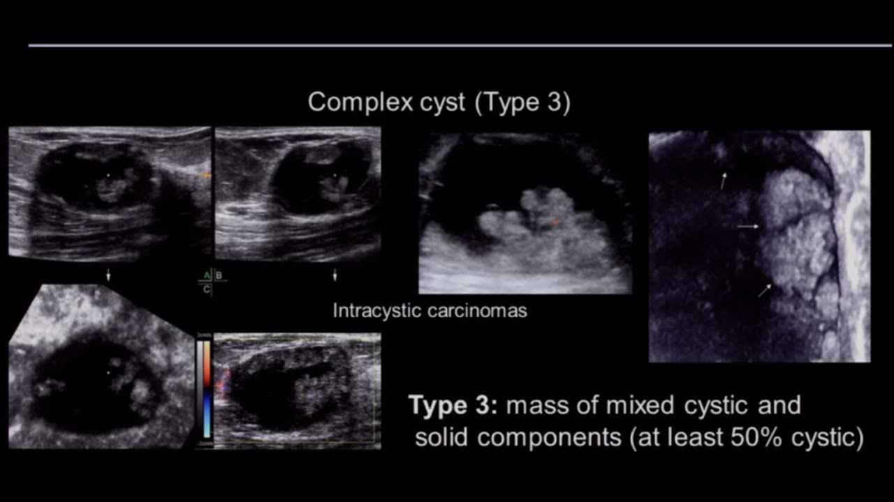 complicated cyst とは