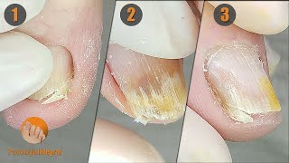 3 cases 1 video (II) | #1 Abrupt edge toenail | #2 Apical subungual blister | #3 Onychophosis