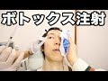 ボトックス体験！目尻のシワ 眉間のシワ エラ張り防止