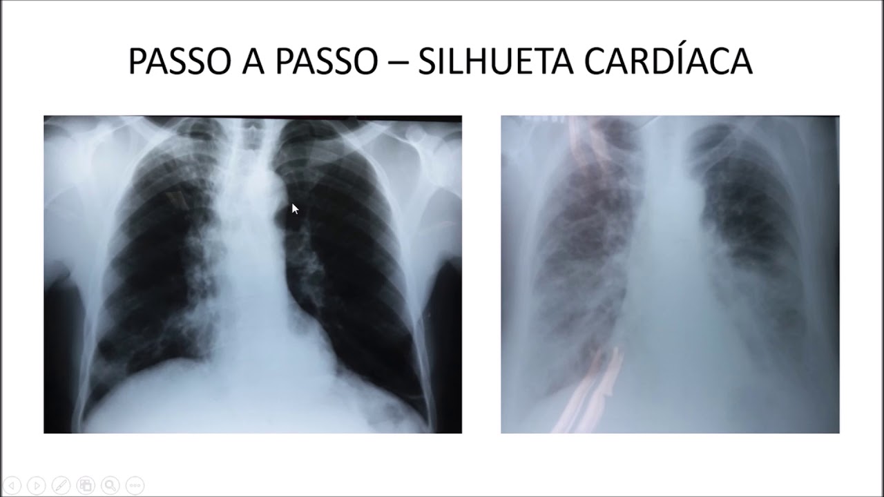 Curso de Radiografia de tórax - Aula 1 - Analisando radiografia de tórax parte 2