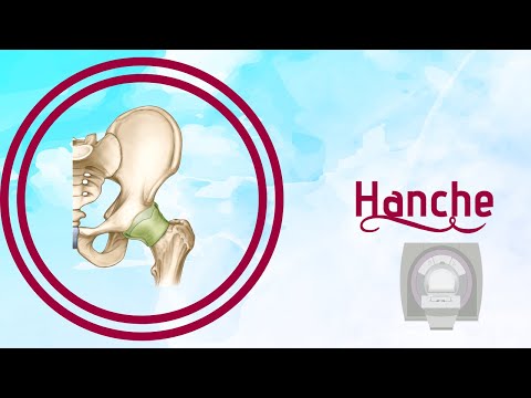 Vidéo: Nécrose De L'articulation De La Hanche