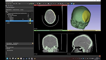 Mirroring for cranioplasty in a 3D slicer. Mirroring transformation --- Elastix registration