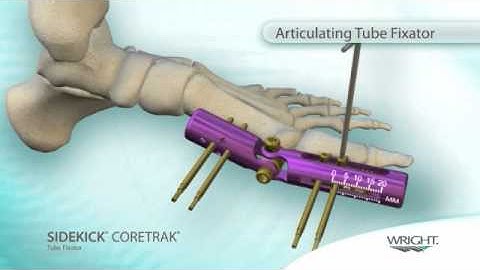 Sidekick Coretrak External Fixator Video
