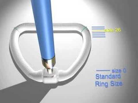 Prolapsed Mitral Valve Repair