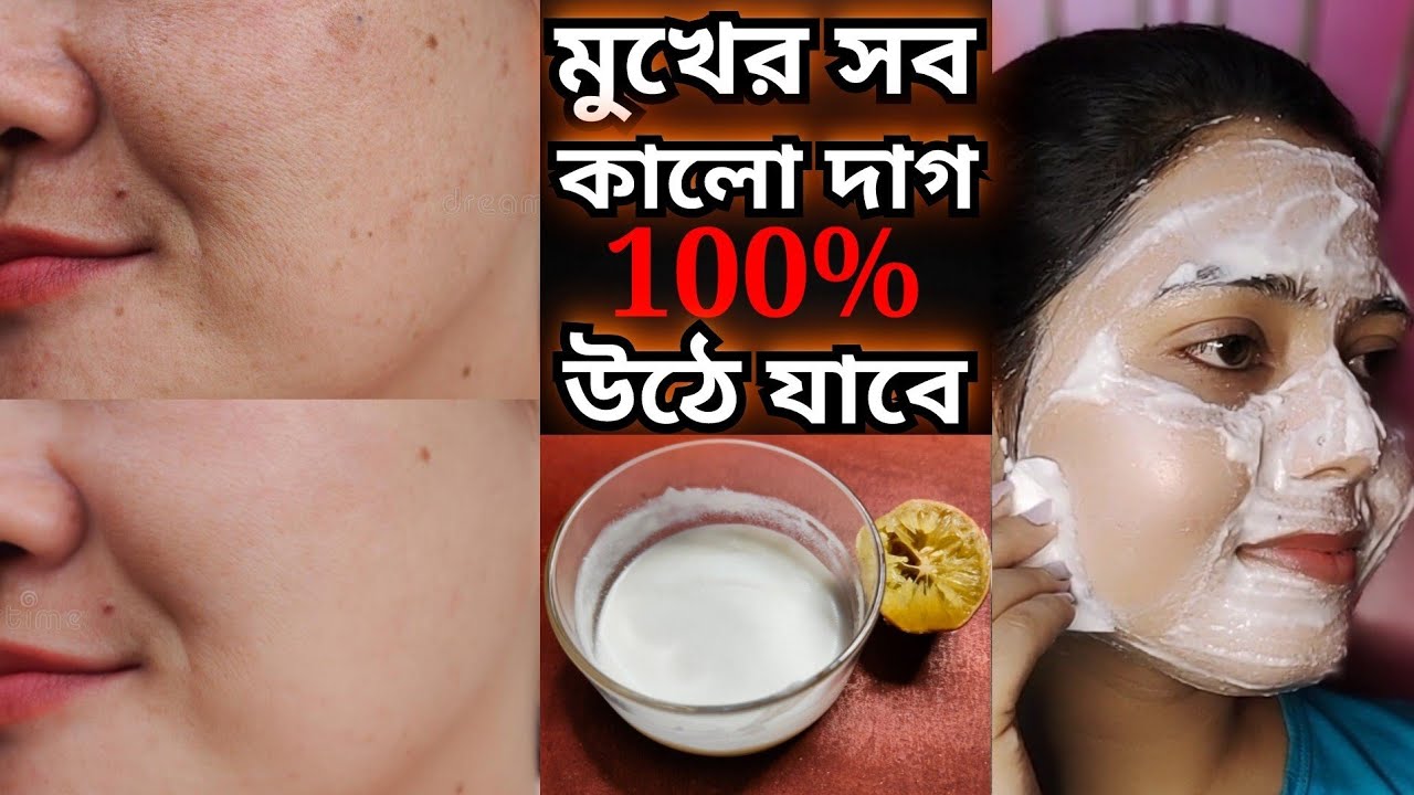 Skin Whitening Challenge ব্রণর দাগ, মেছেতার দাগ ও মুখের যেকোনও কালো