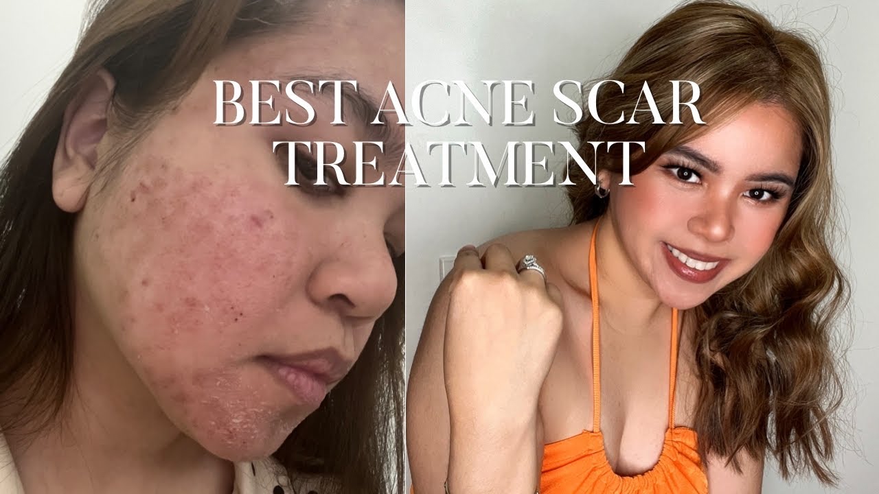 BEST ACNE SCAR TREATMENT | MICRONEEDLING | THEBIGAPPLEGIRL