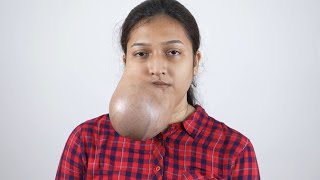 Giant Facial Tumor on Face Pre Surgery Complete Consultation