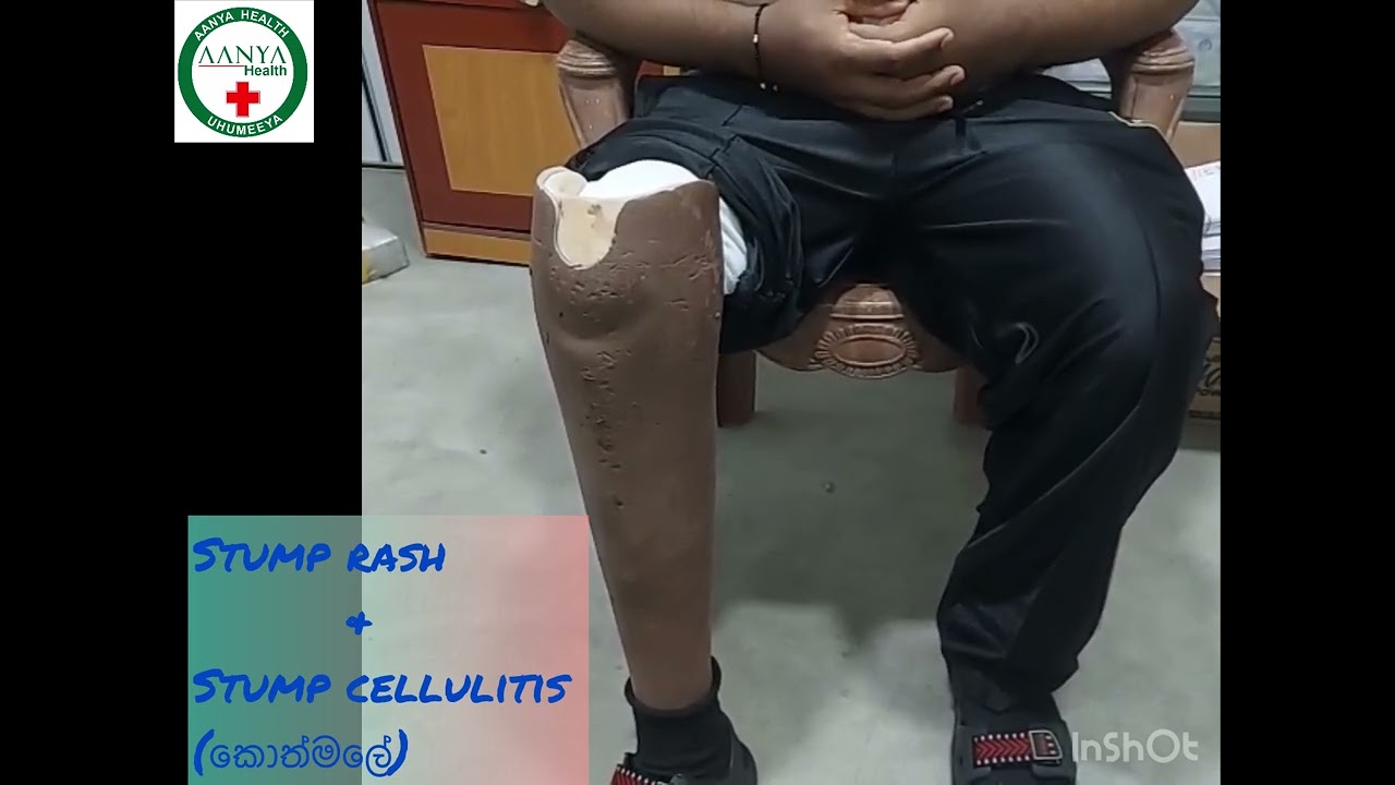 ✅👨‍⚕️🙏සතුටුයි පුතා උඹ වගේ වතාවක්  වැටුණු කෙනෙකුට ආයෙත් නොවැටී ඉන්න ශක්තියක් වෙන්න පුළුවන් වීම ගැන.,!