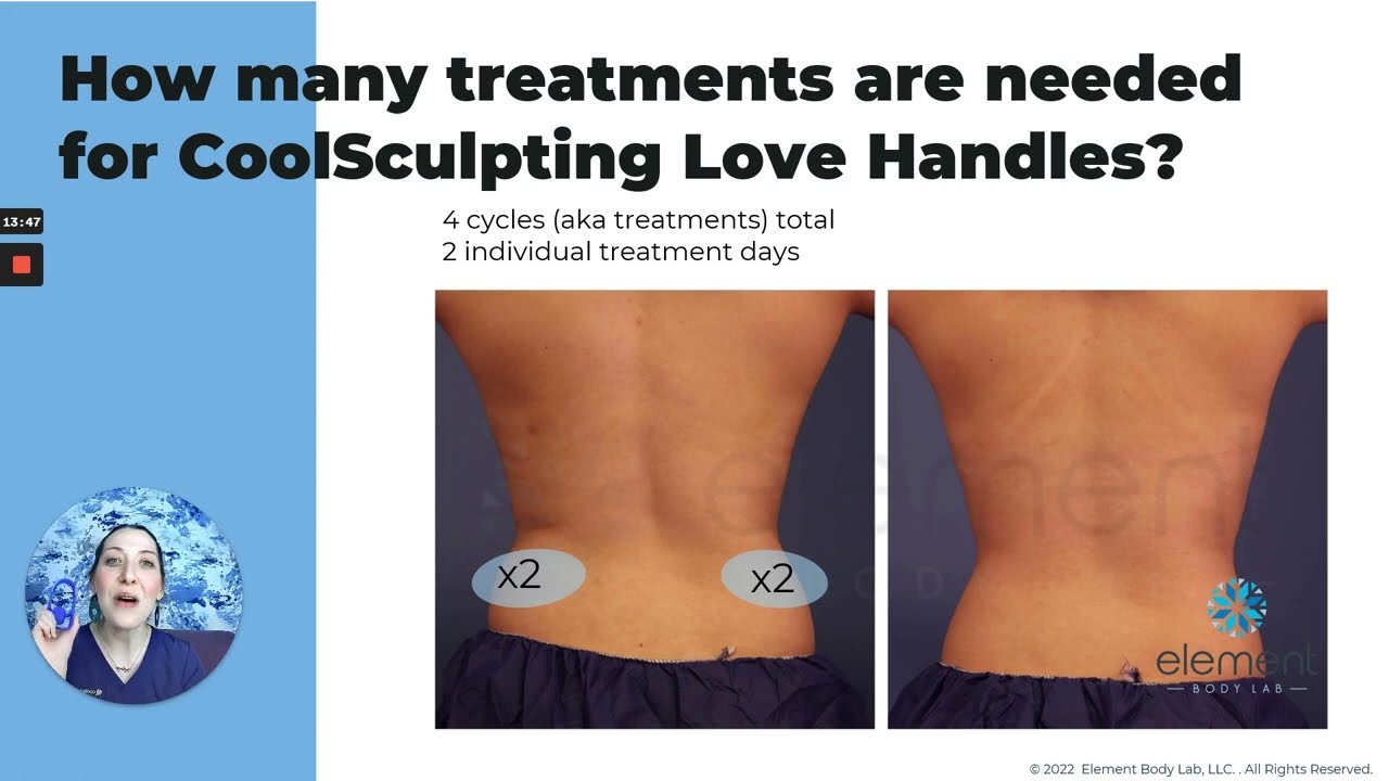 Get Rid of Bra Fat Flanks With Coolsculpting Beverly Hills