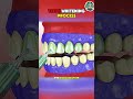The teeth whitening process that actually works #teethwhitening #shorts