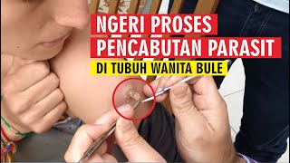 NGERI PROSES PENJABUTAN PARASIT DI TUBUH WANITA BULE