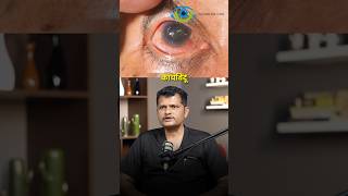 तुम्हाला पण हा डोळ्यांचा आजार असू शकतो #cataract #glaucoma #eyediseases