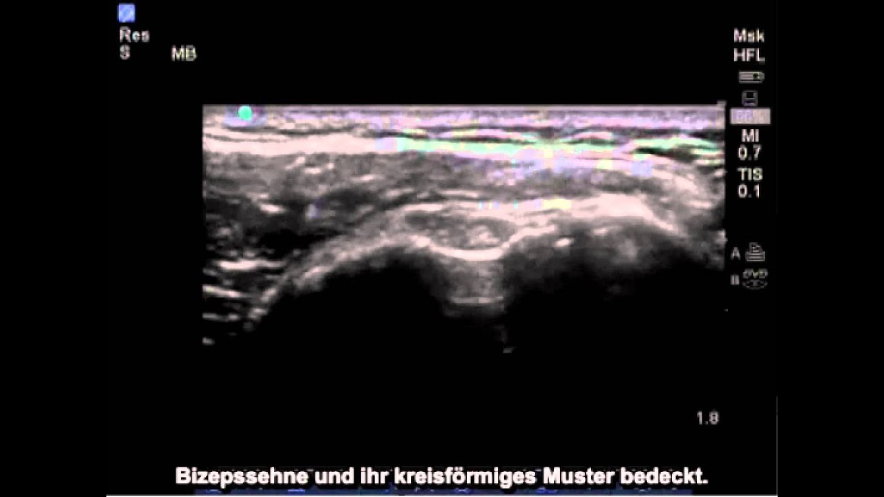 Anleitung Ultraschalluntersuchung der Bizepssehne YouTube
