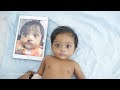 Cleft Lip Surgery in India - Birth Defect Correction