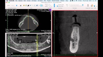 Dental3DPlugin 2.0 : how to draw an implant