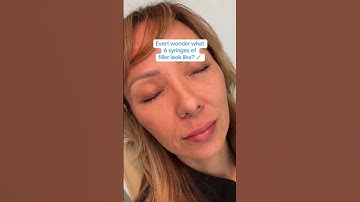 6 Syringes Of Filler 💫💉