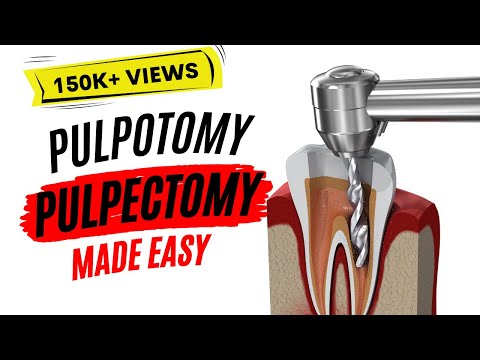 वीडियो: क्या पल्पोटॉमी और पल्पेक्टोमी एक ही चीज़ है?