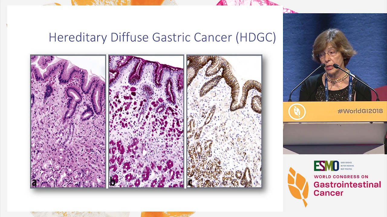 Keynote Lecture: Hereditary aspects of gastric cancer