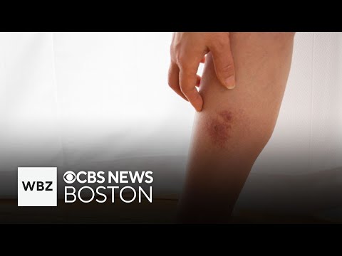 What is cellulitis and how can it be treated?