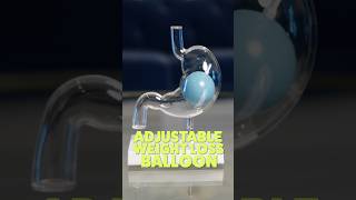 The Worlds First Adjustable Weight Loss Balloon - The Spatz3 Gastric Balloon