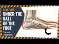 Blisters Under The Ball Of The Foot: Cause & Prevention