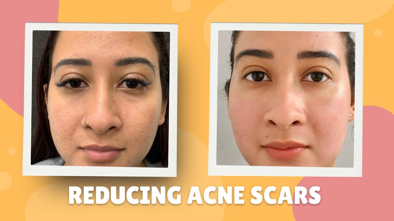 CHANGING LIVES BY REDUCING ACNE SCARS IN THIS HISPANIC PATIENT WITH