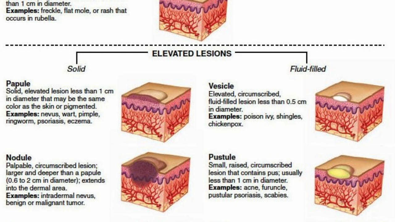 Types Skin Lesion Chart