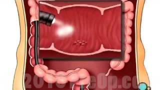 Oncology Patient Education Endoscopy of Large Intestine