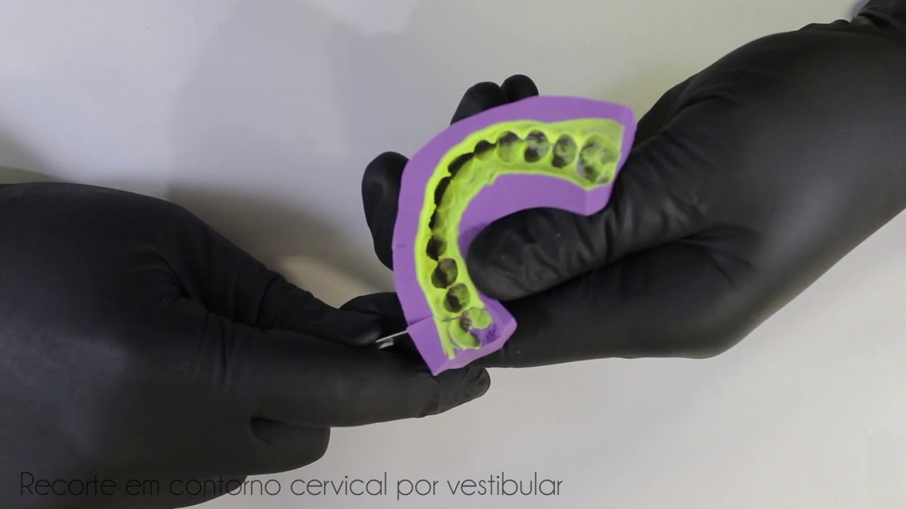 Mock Up Com Resina Bisacrilica Da Confeccao Do Guia De Silicone A Instalacao Em Boca Youtube